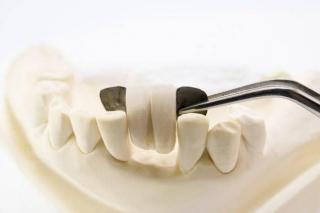 Prótesis Dental Foto